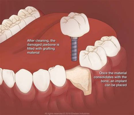  ¿Zinc Oxide: Una Maravilla Invisible para Implantes Óseos Duraderos?